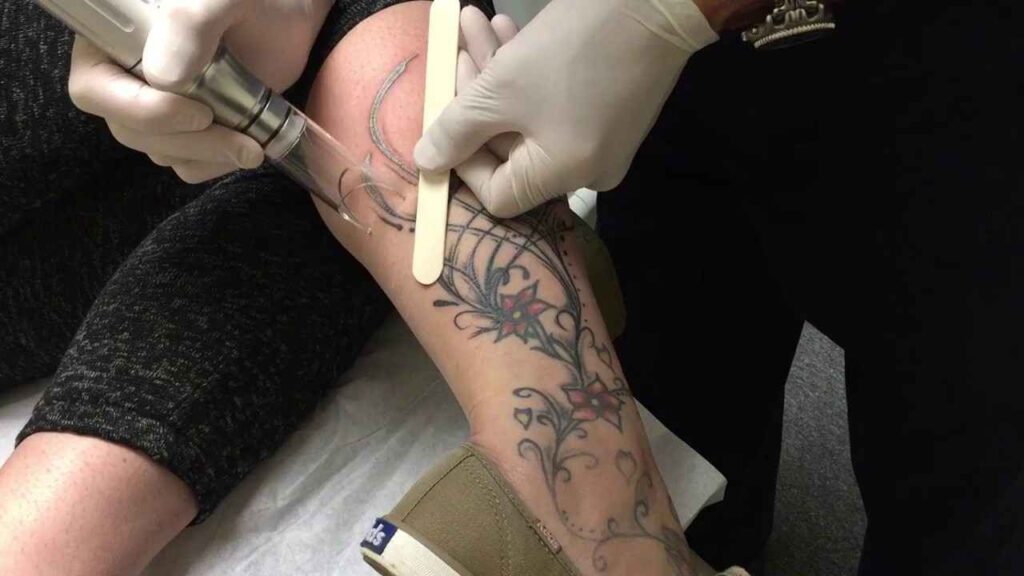Tattoo Removal Near Me 