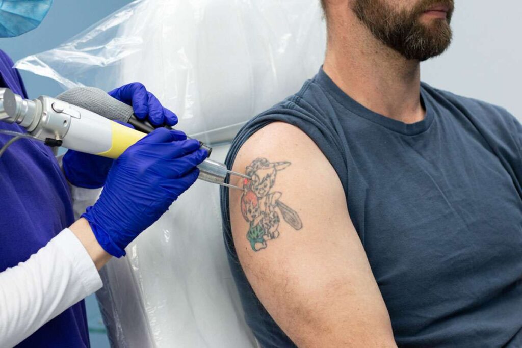 Tattoo Removal Near Me 